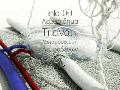 Λεμφοίδημα - Τι είναι η Μεταμόσχευση Λεμφαδένων | Κλινική για το Λεμφοίδημα | The Lymphedema Clinic